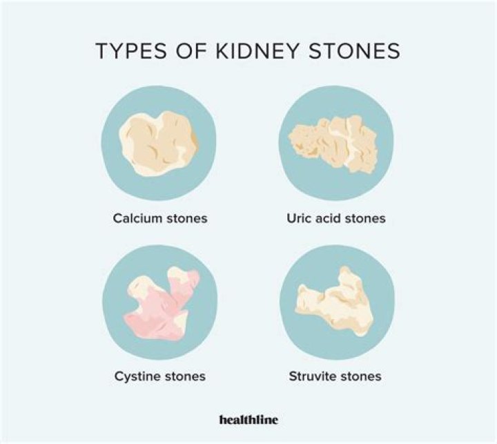Kidney Stones: 5 Things To Know About Ailment That Sent Liam Hemsworth To The Hospital